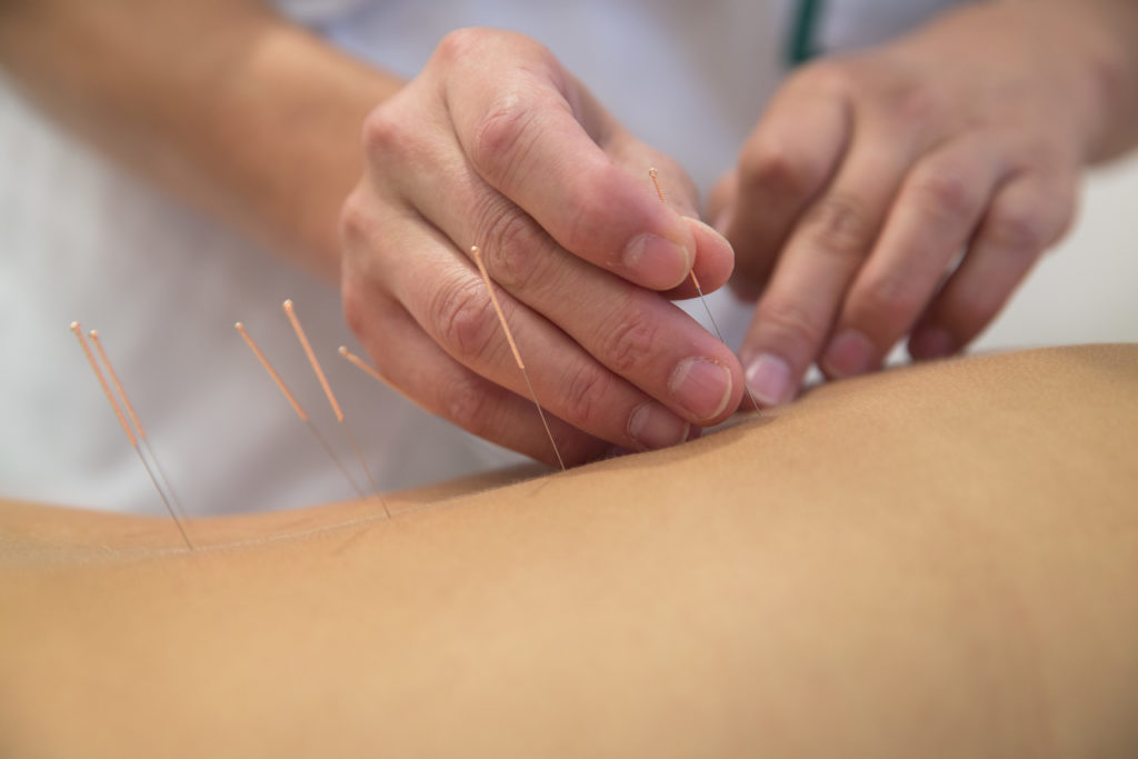 Acupuncture & Physical Therapy, a Perfect Pair